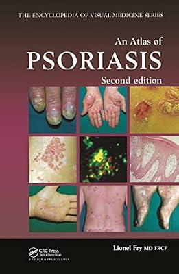 AN ATLAS OF PSORIASIS (ENCYCLOPEDIA OF VISUAL MEDICINE) (ENCYCLOPEDIA OF VISUAL MEDICINE SERIES): 77 by Fry, Lionel | Hardcover | Dermatology