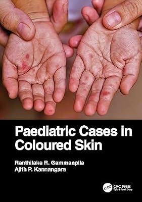 PAEDIATRIC CASES IN COLOURED SKIN (PB 2024) by Kannangara, Ajith P.; Gammanpila, Ranthilaka R. | Paperback | Dermatology