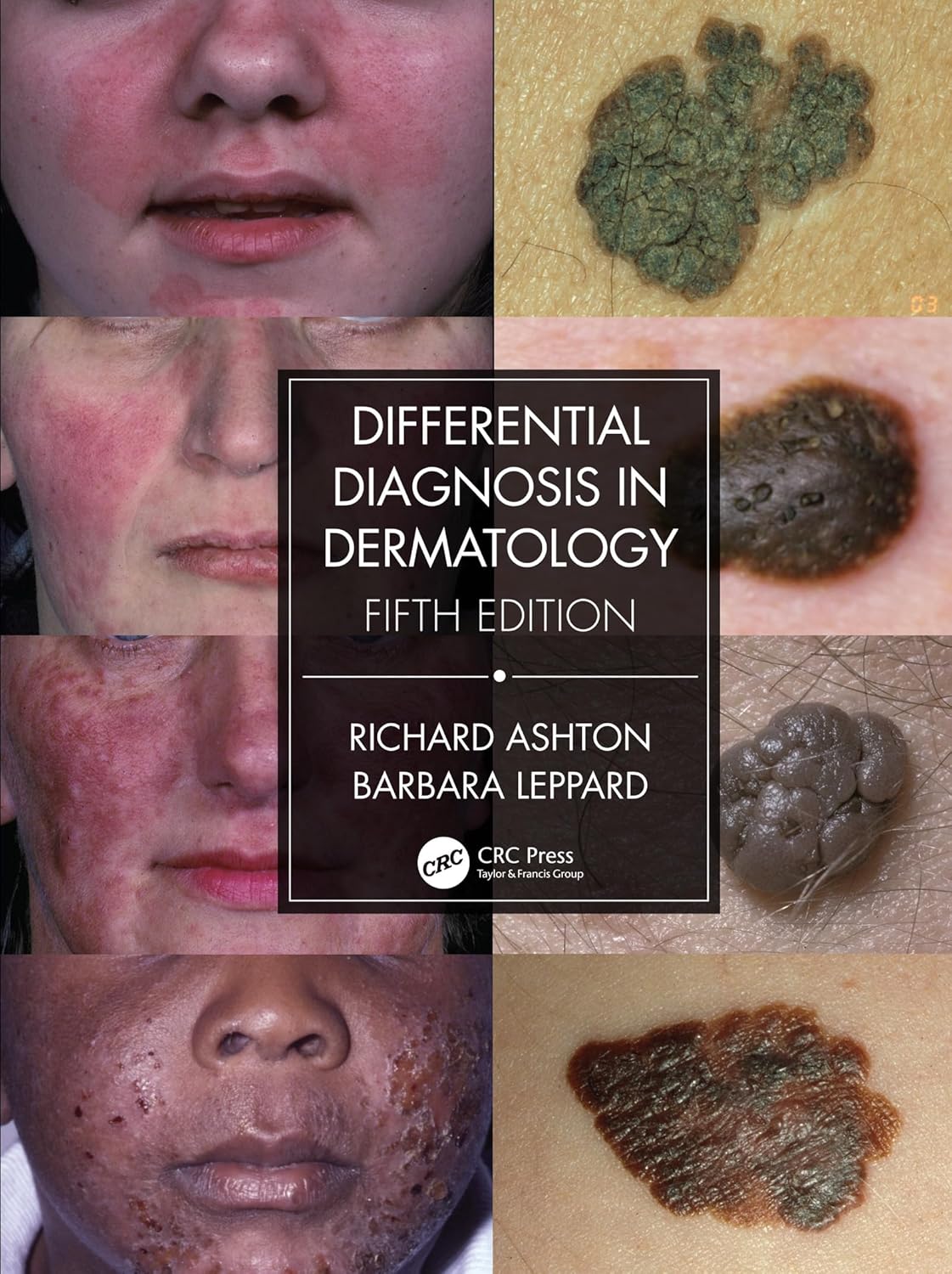 Buy Differential Diagnosis in Dermatology (English, Hardcover, Richard Ashton, Barbara Leppard) Online at Best Price - GlowMirror