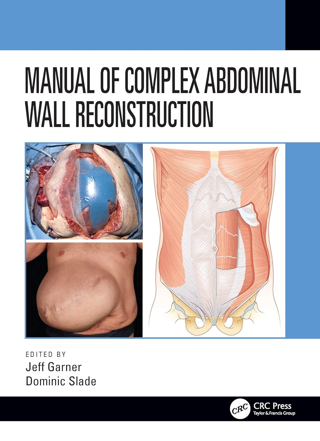 Buy Manual of Complex Abdominal Wall Reconstruction (English, Paperback, Jeff Garner, Dominic Slade) Online at Best Price - GlowMirror