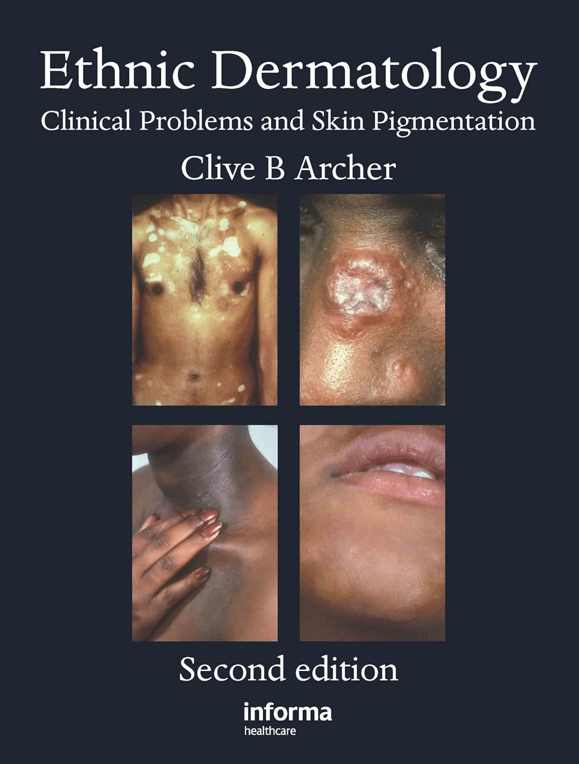 Buy Ethnic Dermatology: Clinical Problems and Skin Pigmentation (English, Paperback, Clive B. Archer) Online at Best Price - GlowMirror