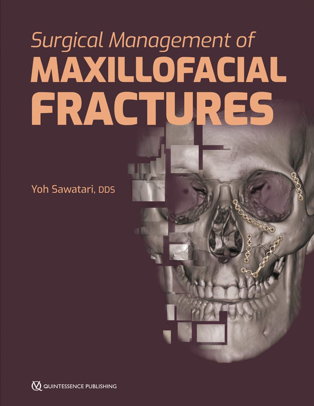 Buy Surgical Management OF Maxillofacial Fractures (HB 2019) (English, Paperback, Sawatari Y.) Online at Best Price - GlowMirror