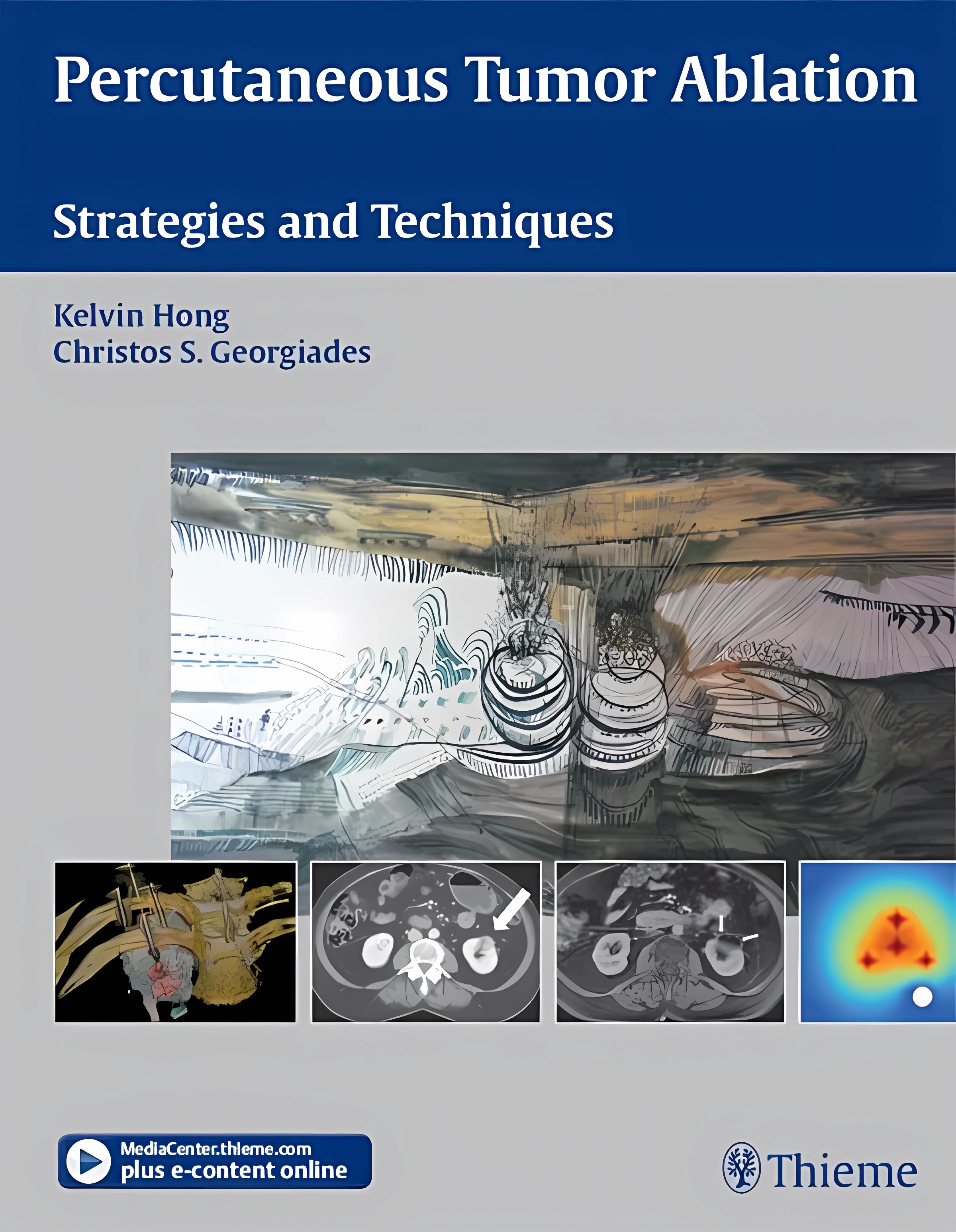 Buy Percutaneous Tumor Ablation: Strategies and Techniques (English, Paperback, Kelvin Hong) Online at Best Price - GlowMirror