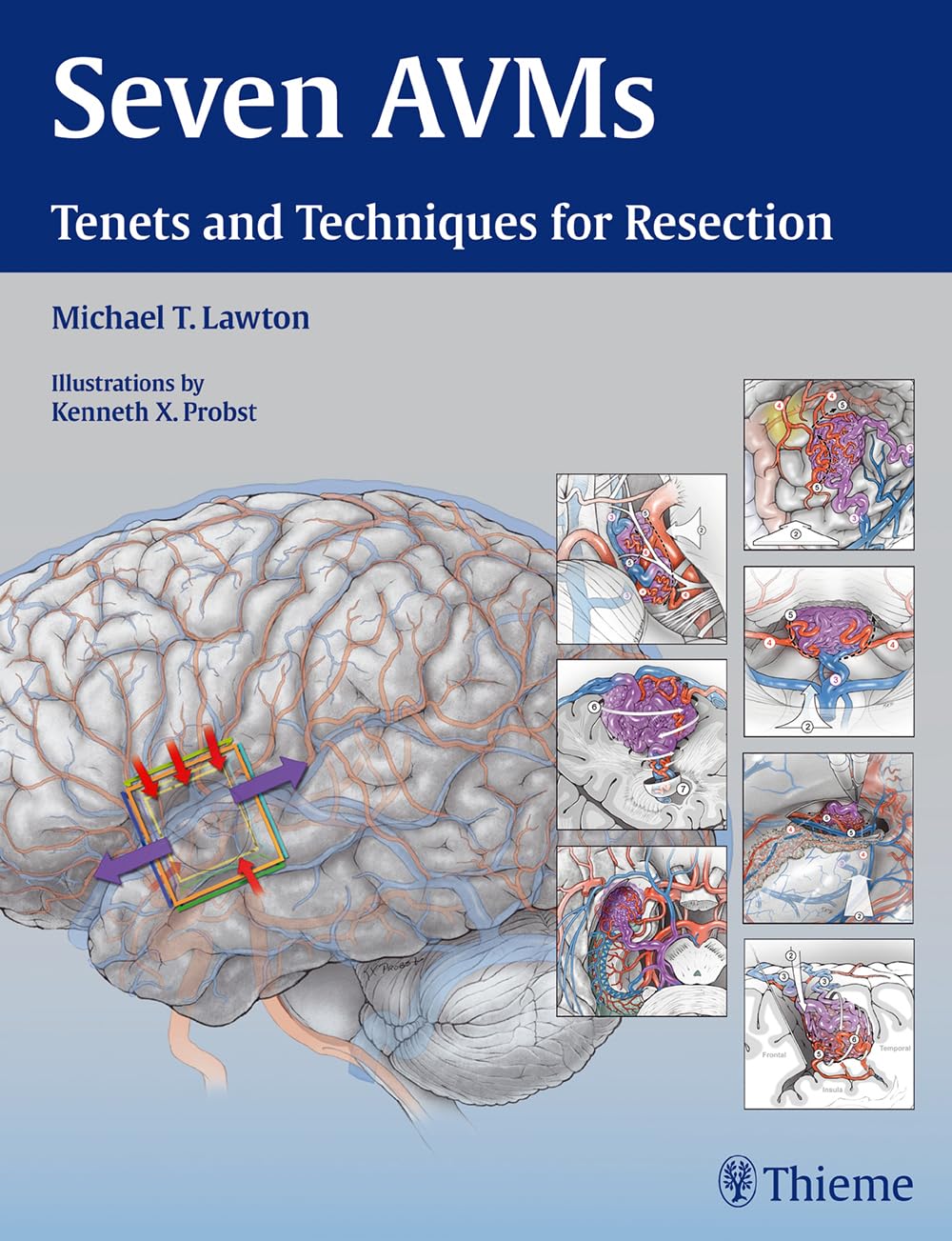 Buy Seven AVMs: Tenets and Techniques for Resection (English, Paperback, Michael T. Lawton) Online at Best Price - GlowMirror