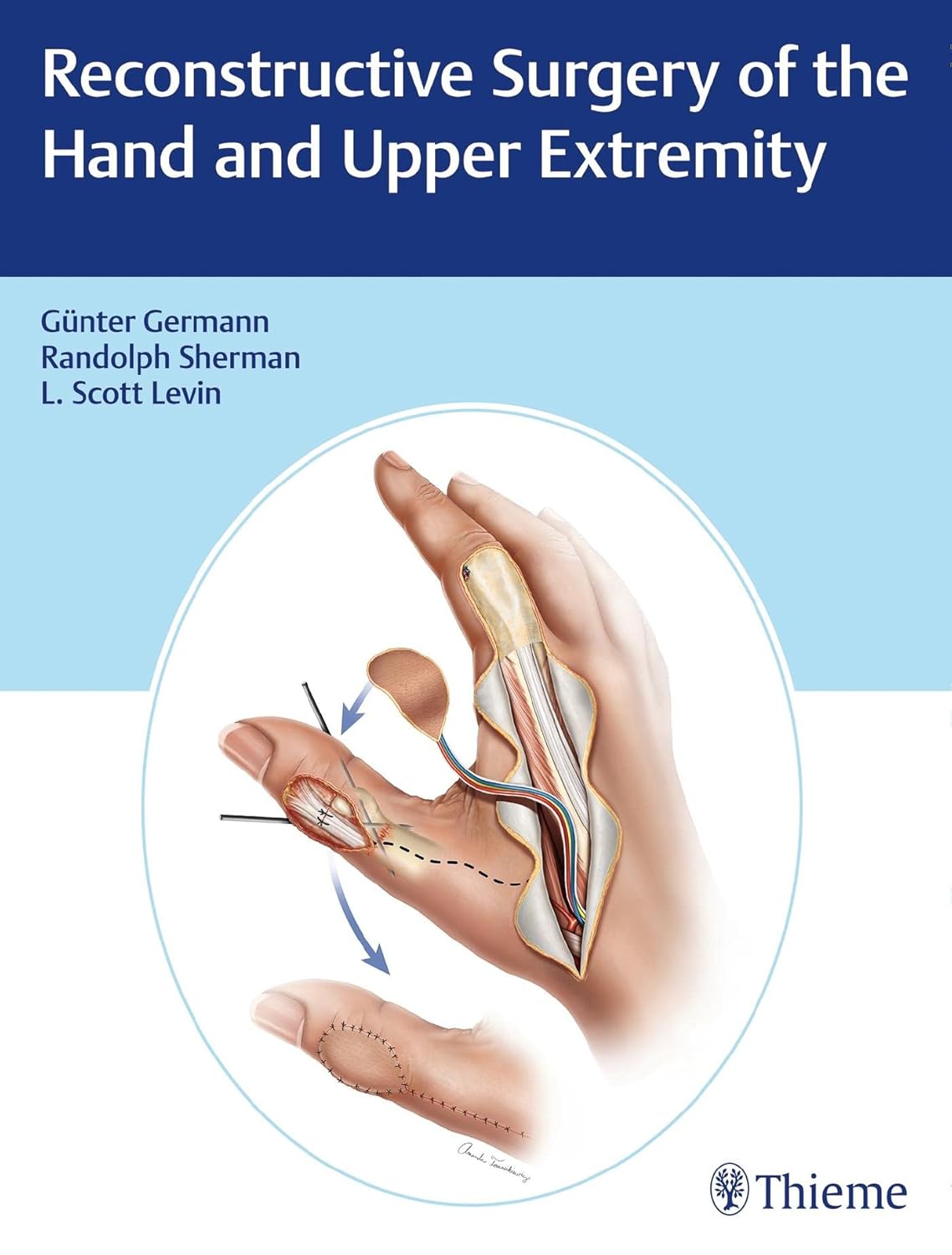 Buy Reconstructive Surgery of the Hand and Upper Extremity (English, Paperback, Gunter Germann, L.Scott Levin, Randolph Sherman) Online at Best Price - GlowMirror