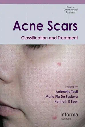 Buy Acne Scars: Classification and Treatment: 6 (Series in Dermatological Treatment) (English, Paperback, Antonella Tosti, Maria Pia De Padova, Kenneth... Online at Best Price - GlowMirror