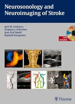 Buy Neurosonology and Neuroimaging of Stroke: A Teaching Atlas (English, Paperback, Jose M. Valdueza) Online at Best Price - GlowMirror