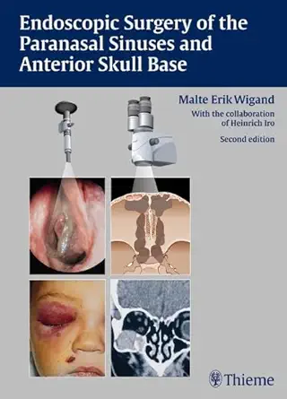 Buy Endoscopic Surgery of the Paranasal Sinuses and Anterior Skull Base (English, Paperback, Malte Erik Wigand) Online at Best Price - GlowMirror
