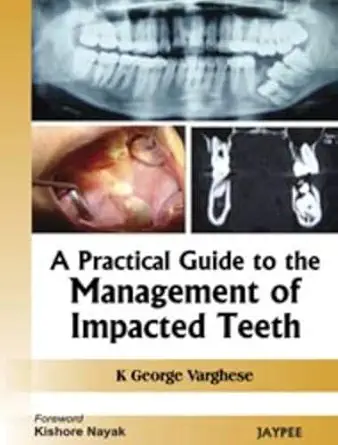 Buy A Practical Guide to the Management of Impacted Teeth (English, Paperback, George Varghese) Online at Best Price - GlowMirror