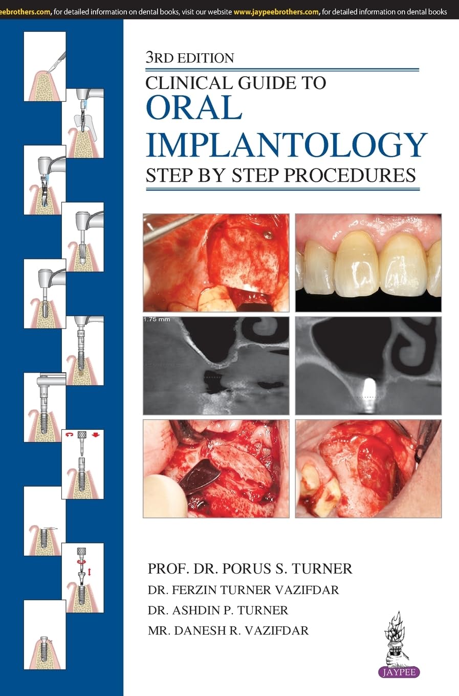 Buy Clinical Guide to Oral Implantology: Step by Step Procedures (English, Paperback, Porus S. Turner) Online at Best Price - GlowMirror